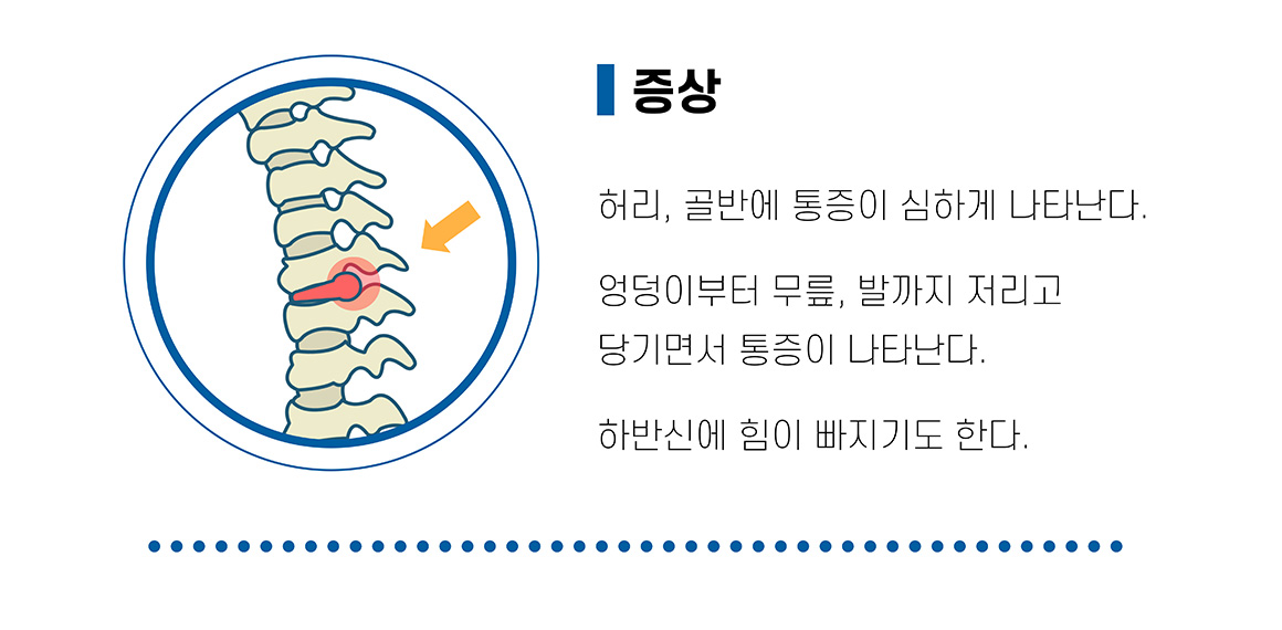 허리디스크 증상