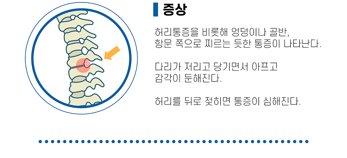 척추관협착증 증상