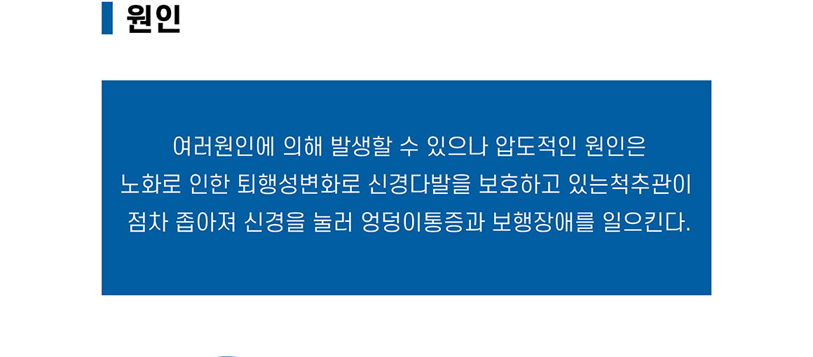 척추관협착증 원인